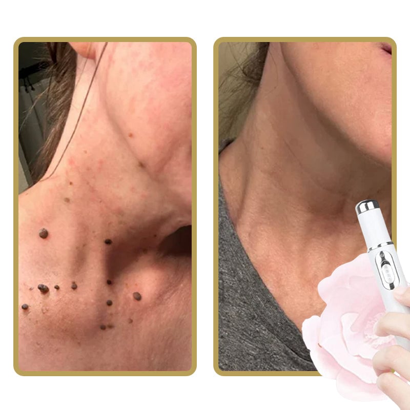 Niet-invasieve laserpen voor het verwijderen van moedervlekken en wratten