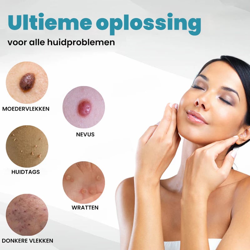 Niet-invasieve laserpen voor het verwijderen van moedervlekken en wratten