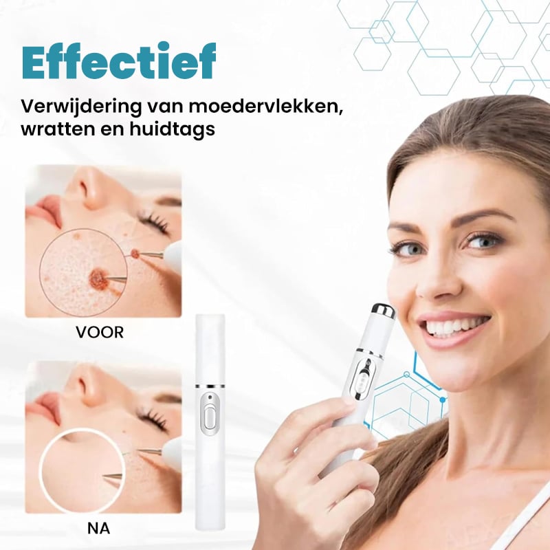 Niet-invasieve laserpen voor het verwijderen van moedervlekken en wratten
